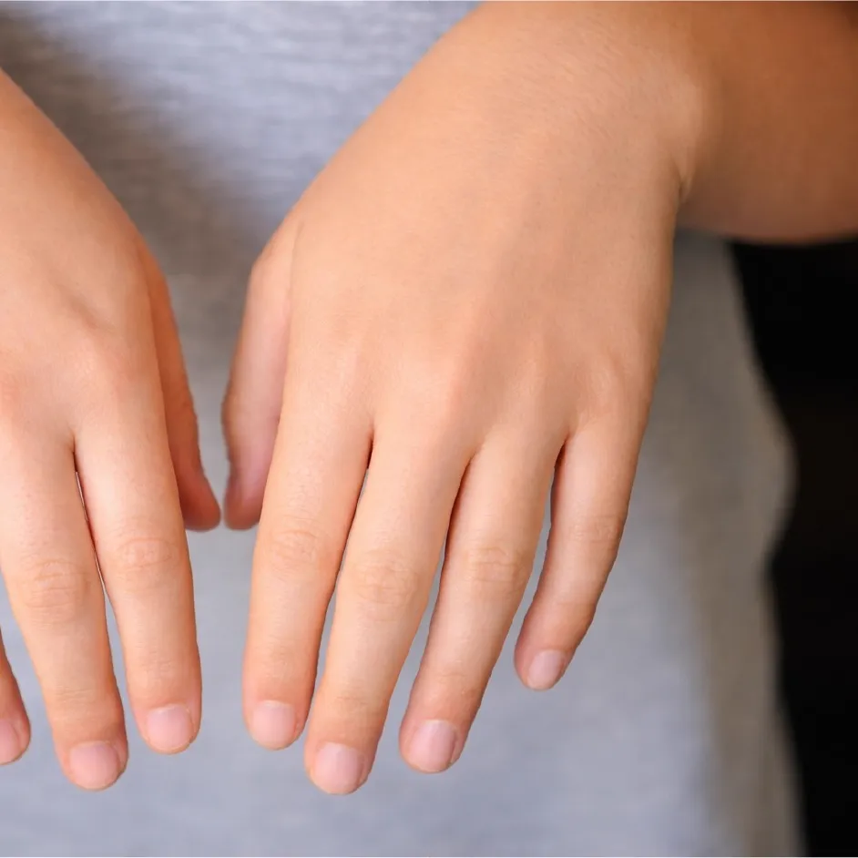 Childhood Eczema Treatment Success - 3 Months Results