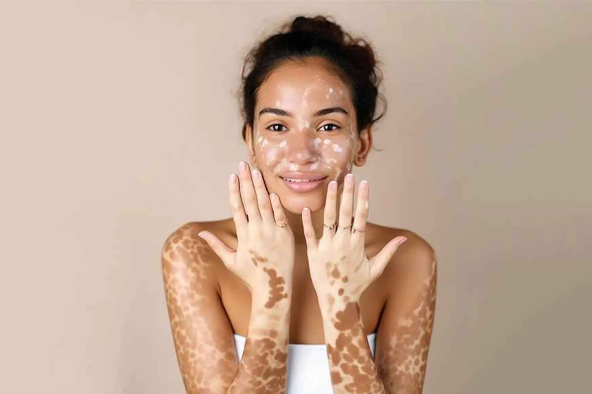 Vitiligo