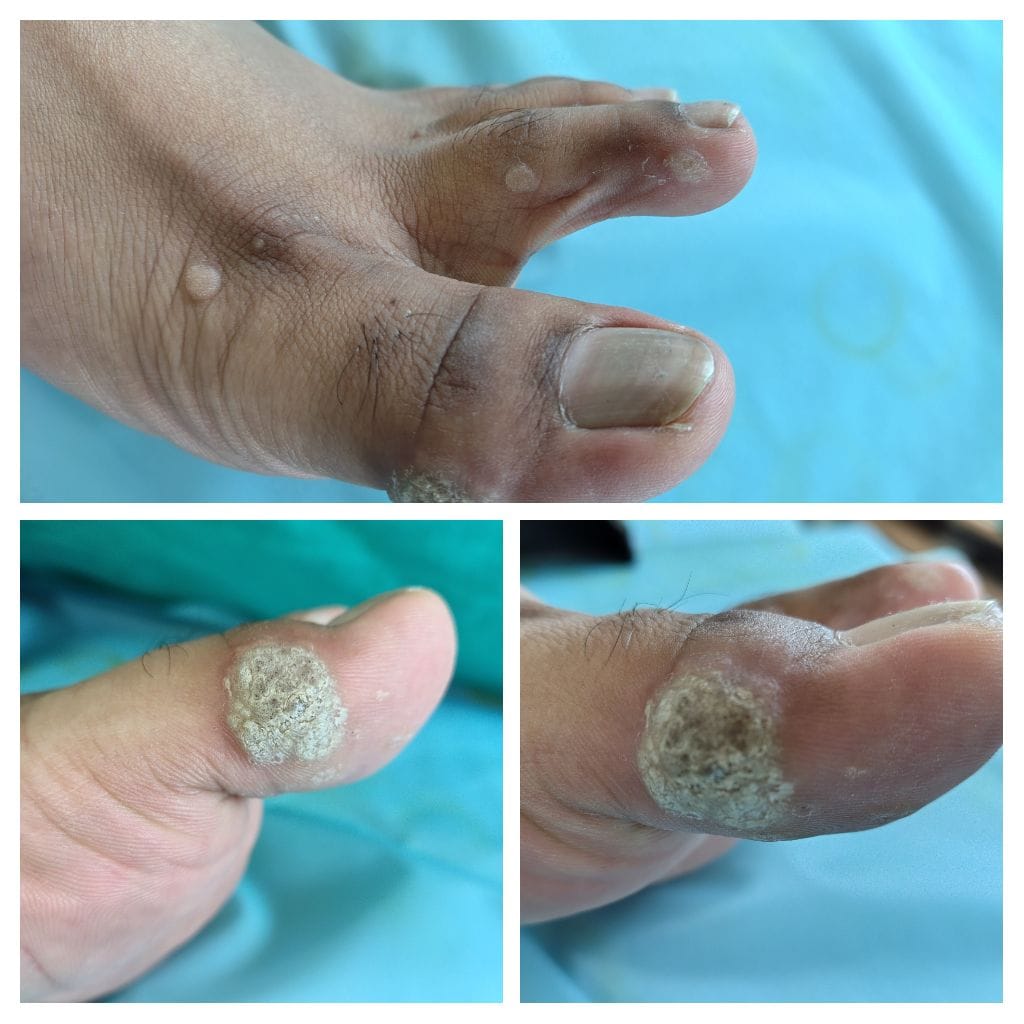 Finger Wart
