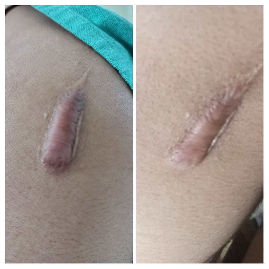 keloid - Skin
