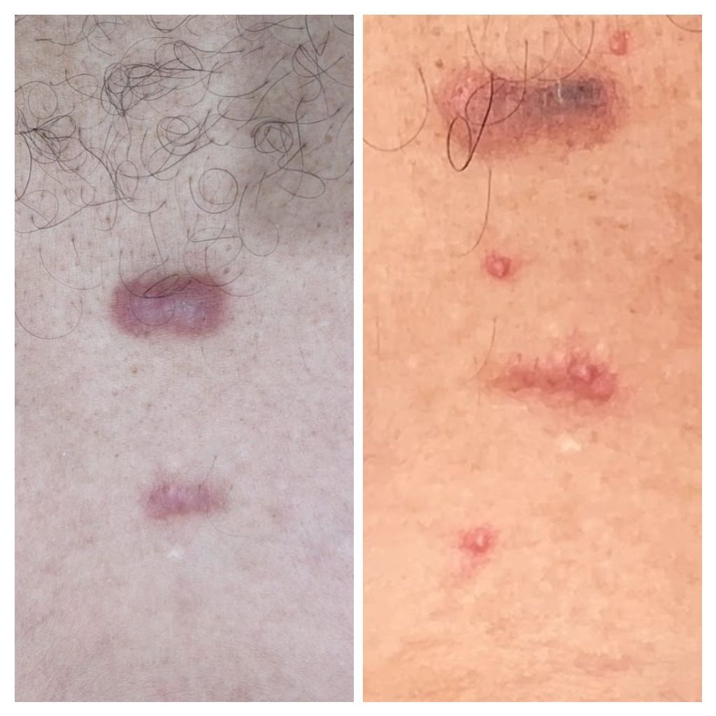 Keloid - Skin