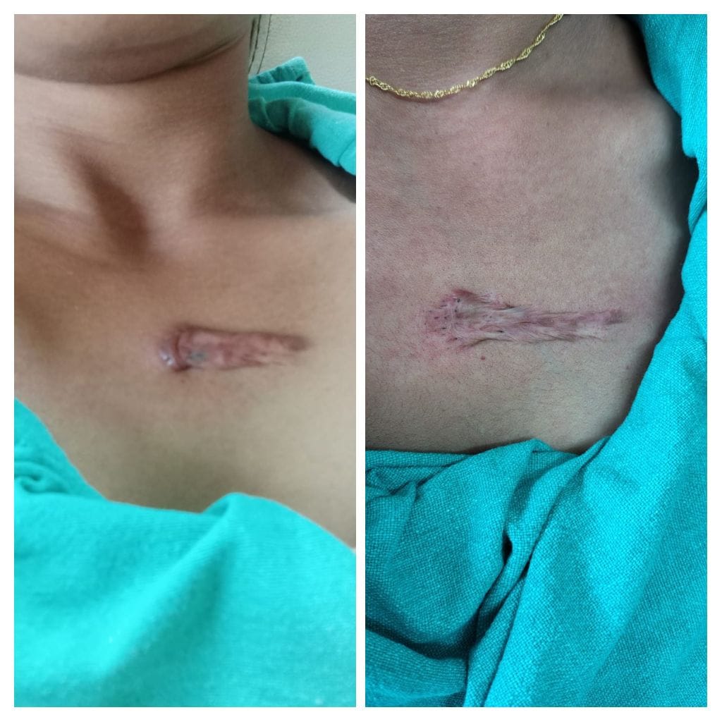 Keloid - Skin