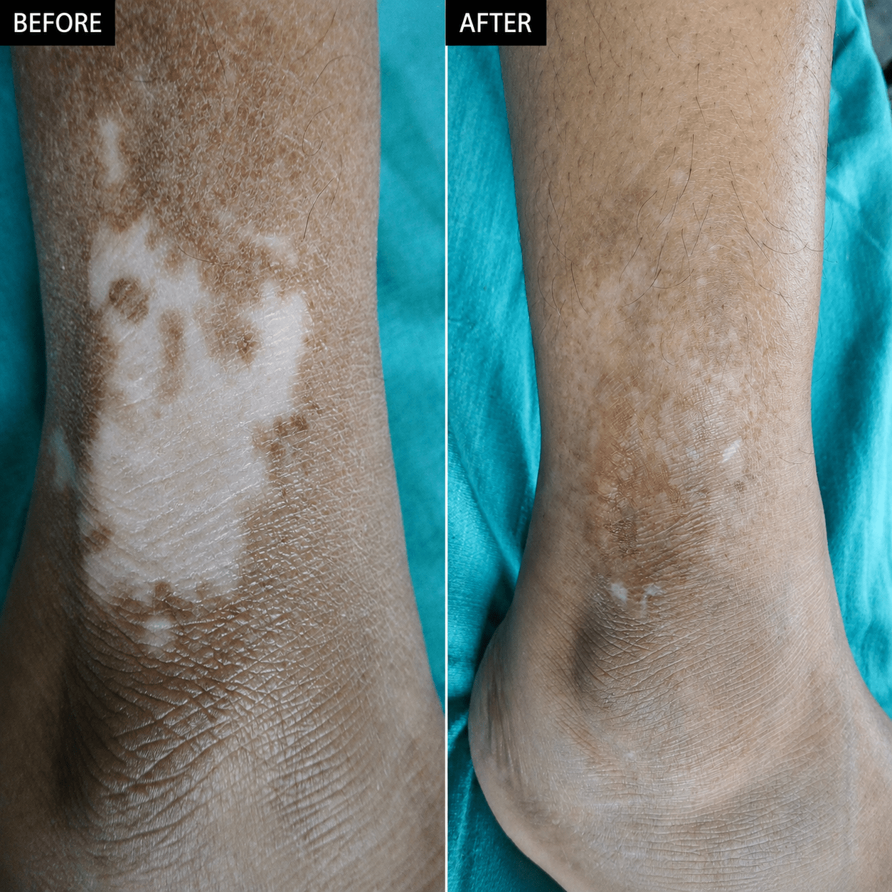 Vitiligo