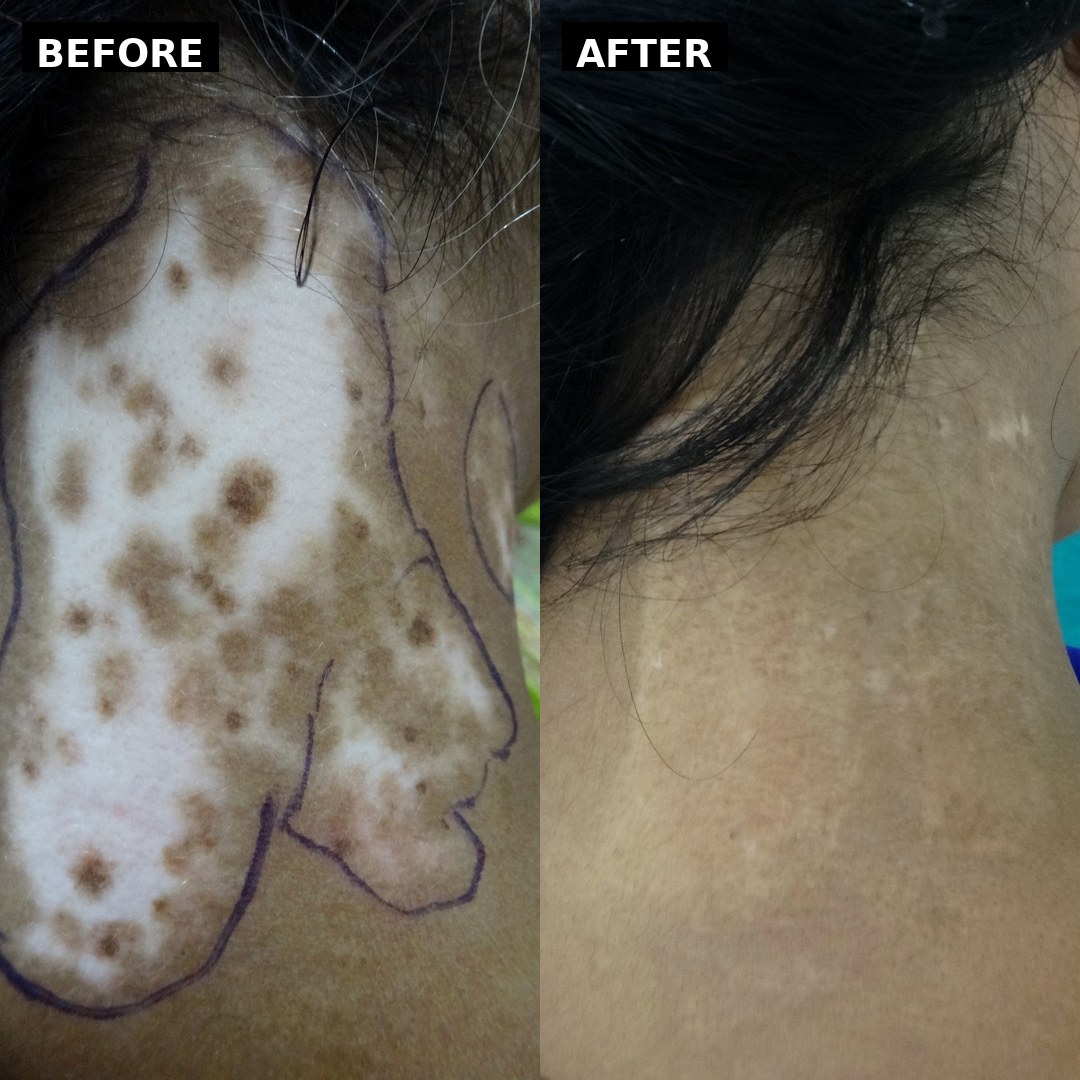 Vitiligo