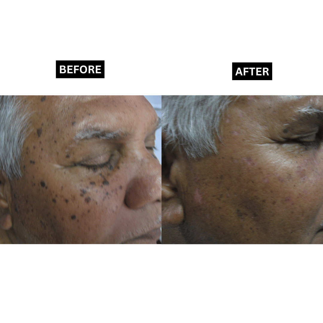 Seborrheic Keratosis