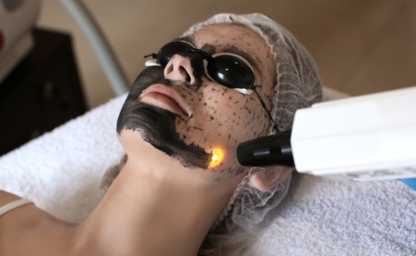 Carbon Peel
